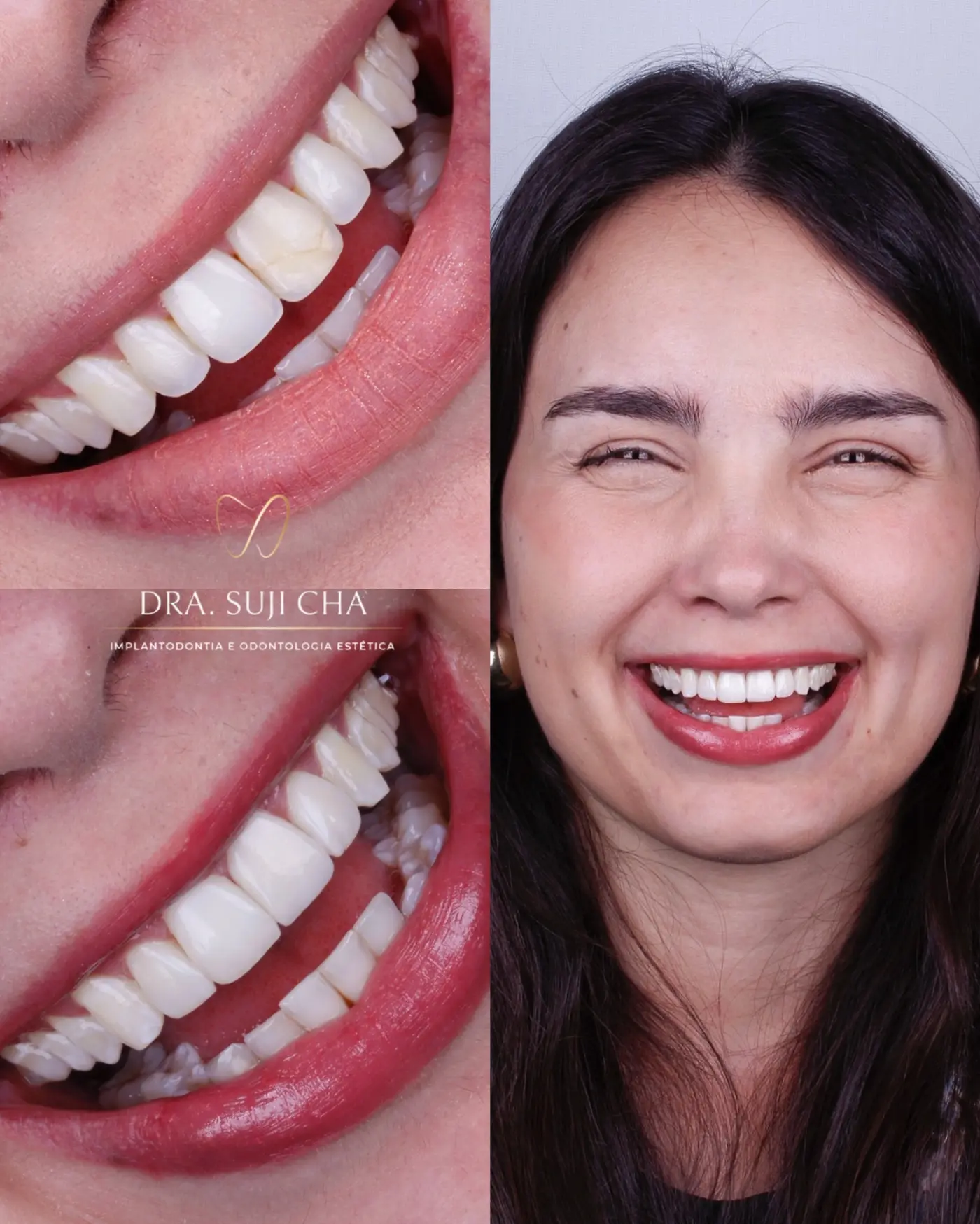Antes e depois de caso clínico de estética dental