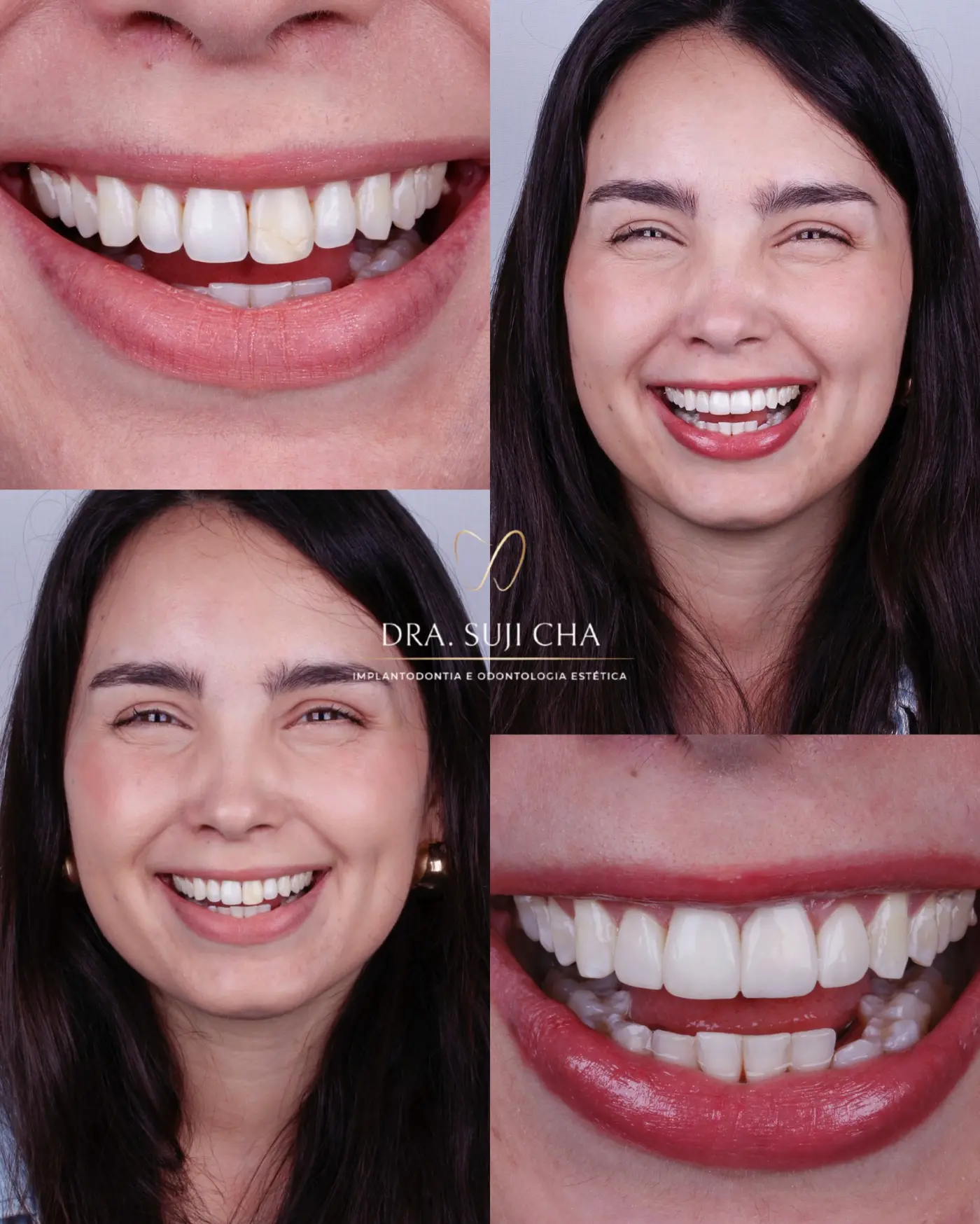Antes e depois de caso clínico de estética dental