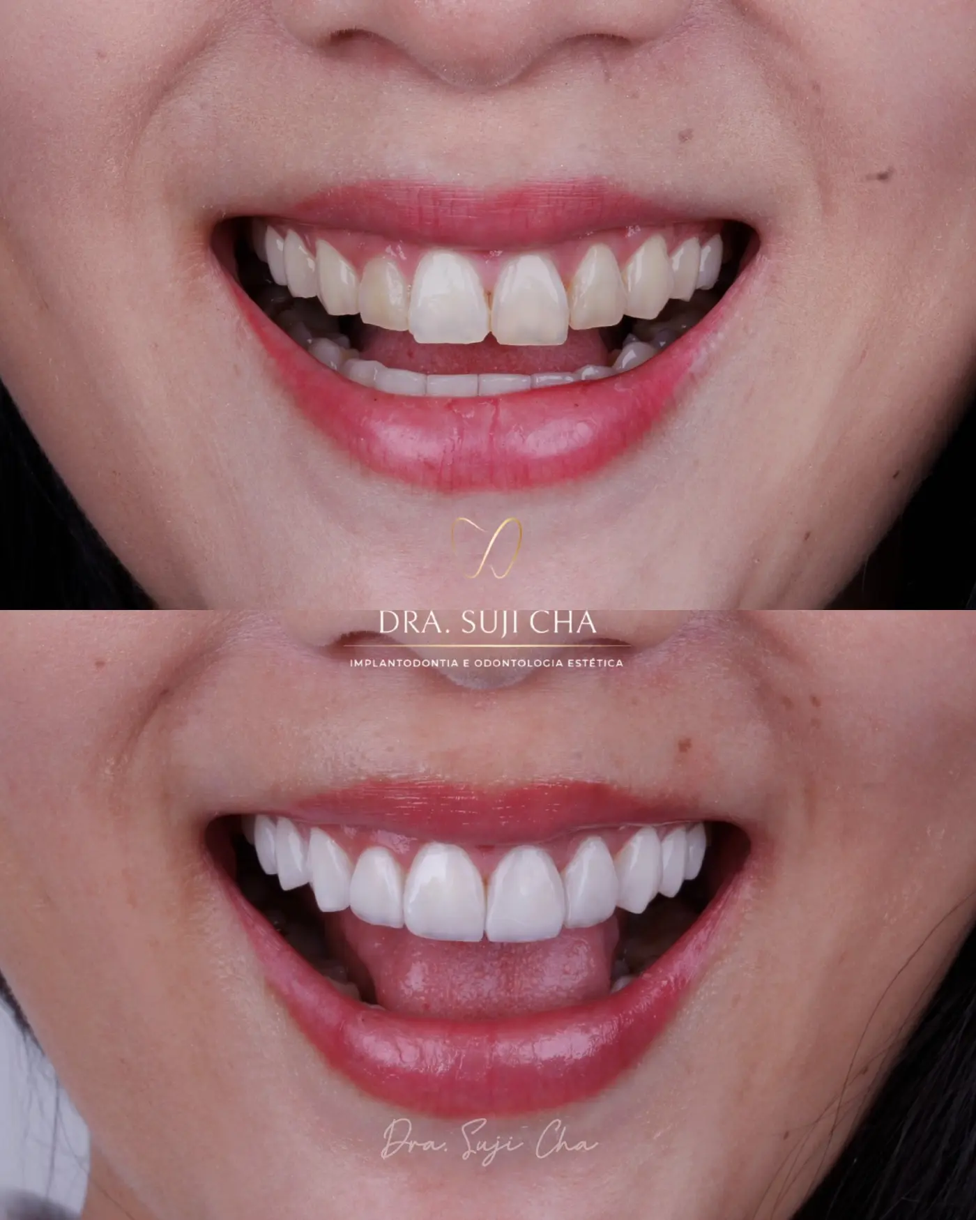 Antes e depois de caso clínico de estética dental
