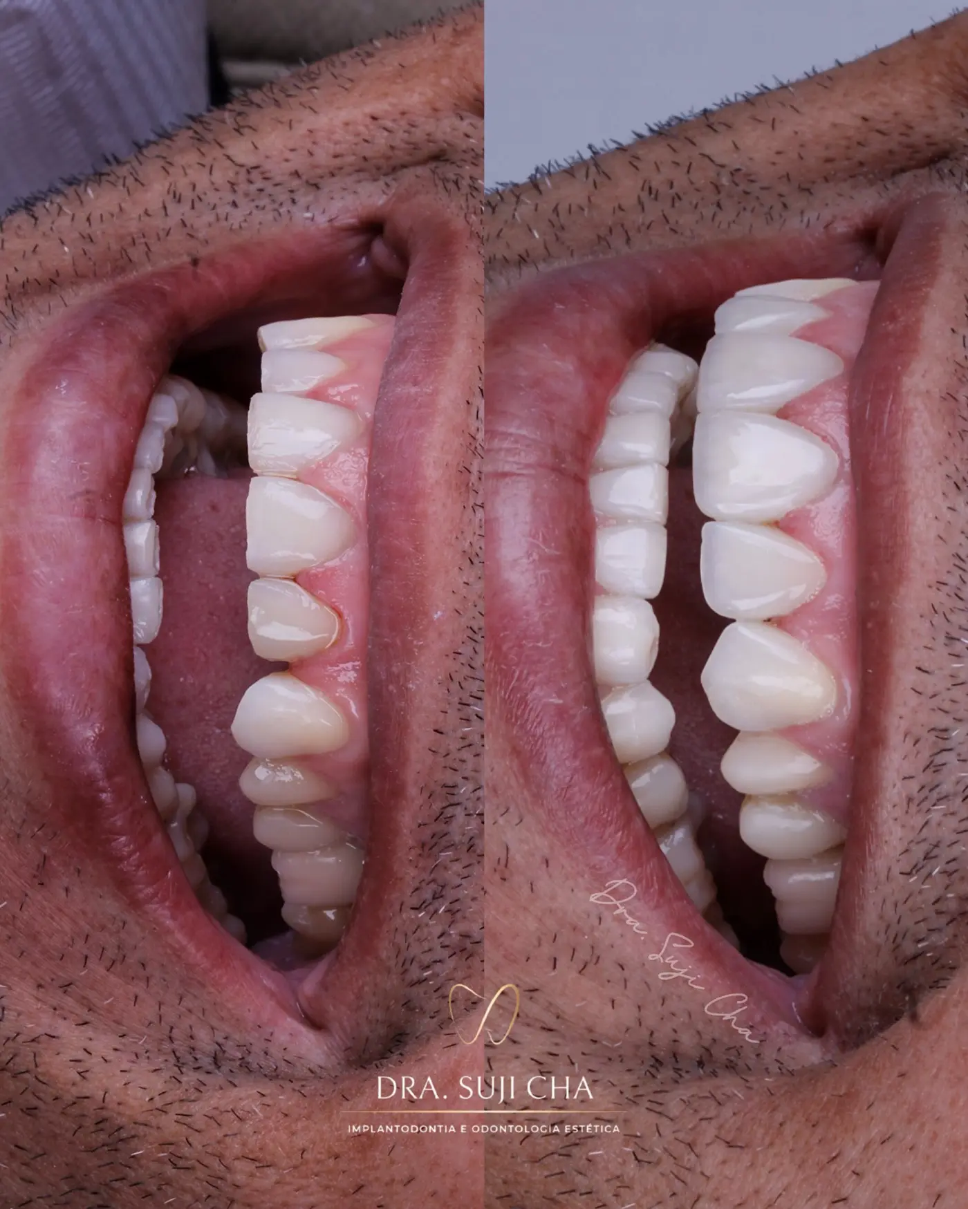 Antes e depois de caso clínico de estética dental