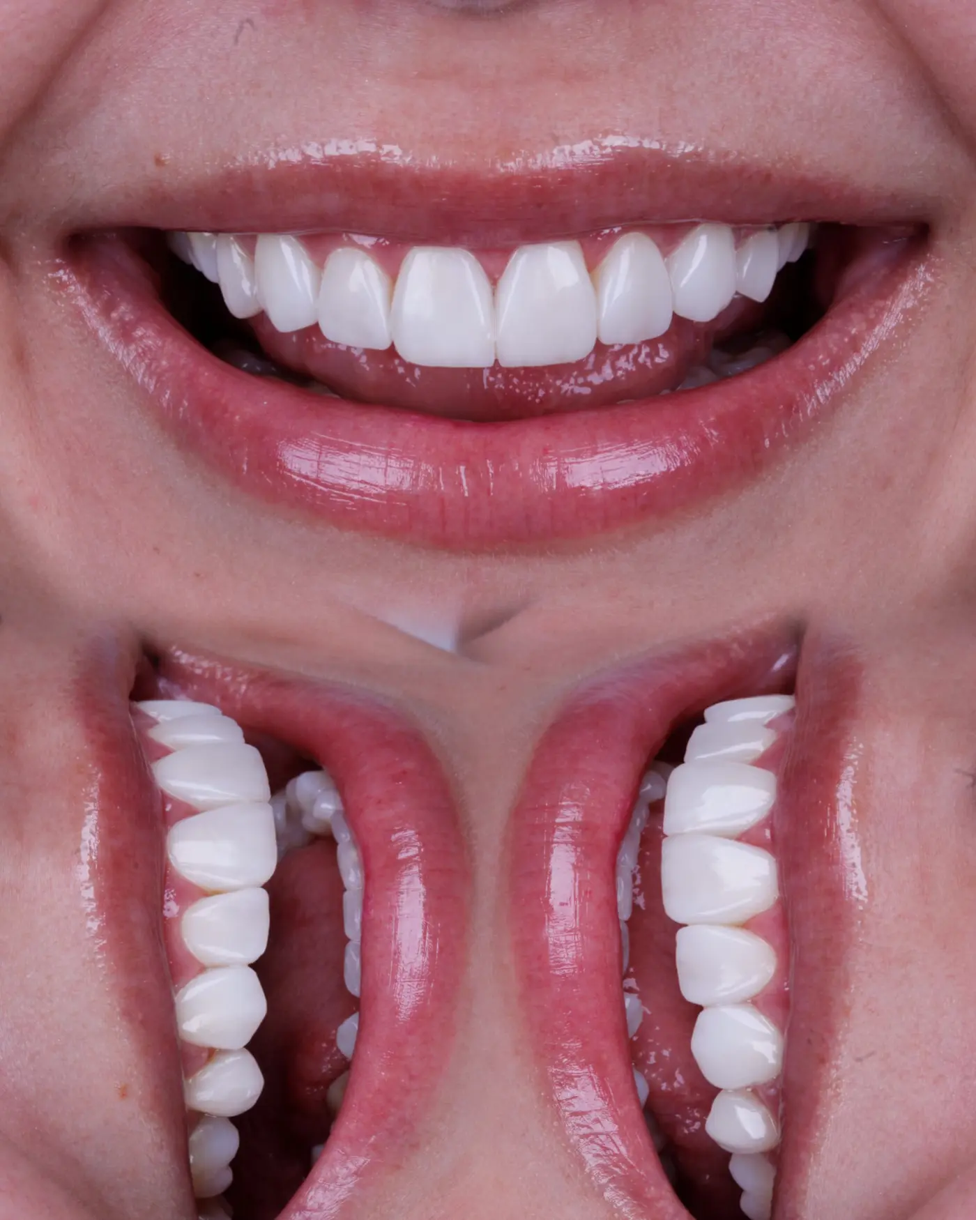 Antes e depois de caso clínico de estética dental