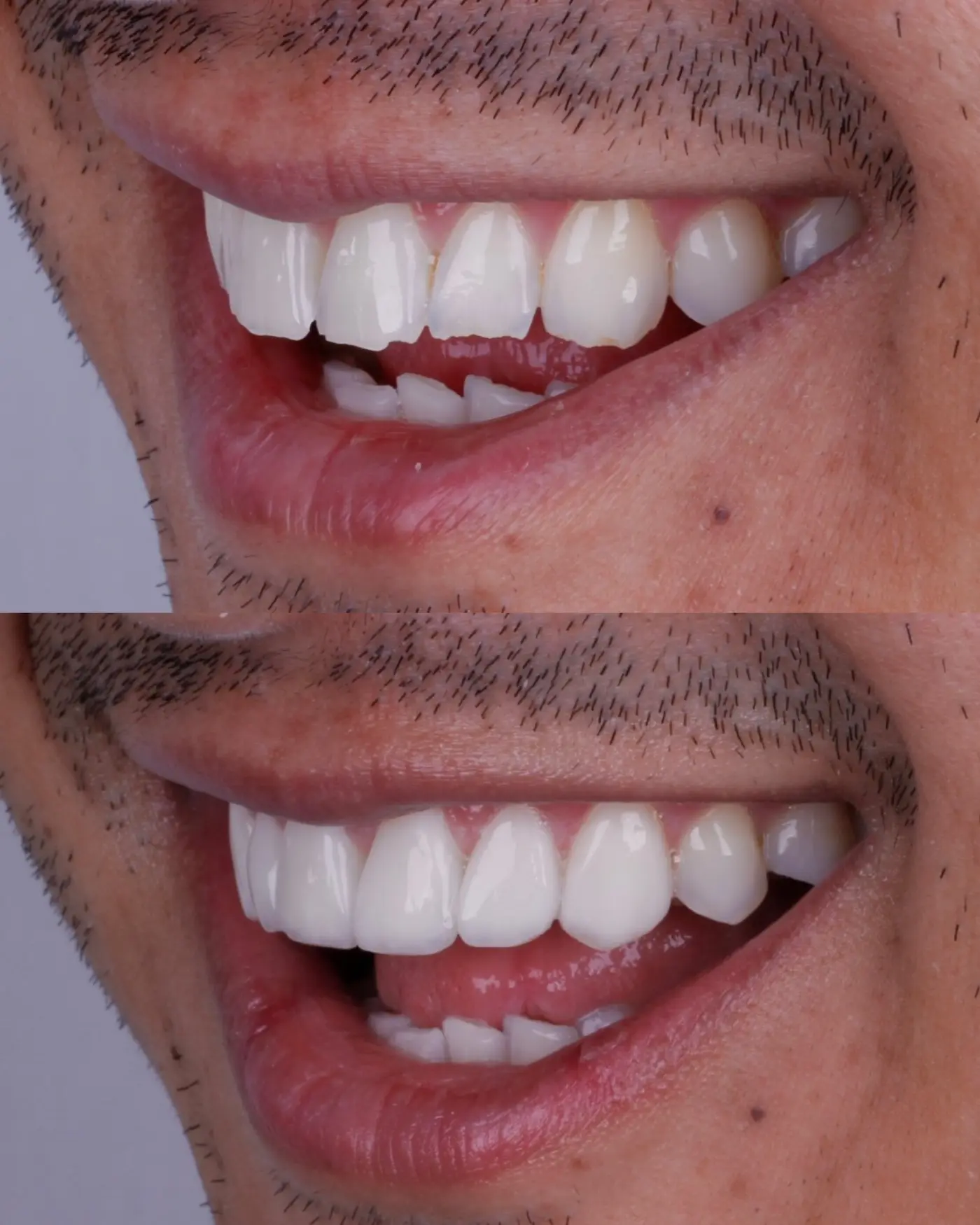 Antes e depois de caso clínico de estética dental