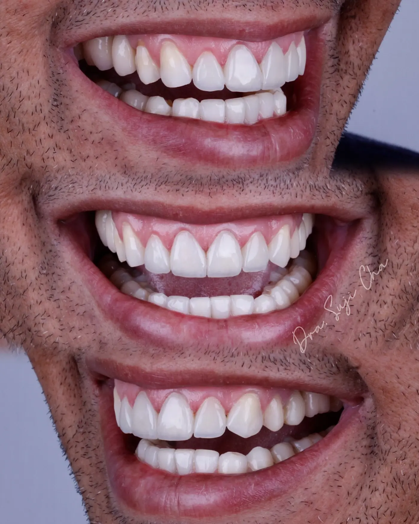 Antes e depois de caso clínico de estética dental