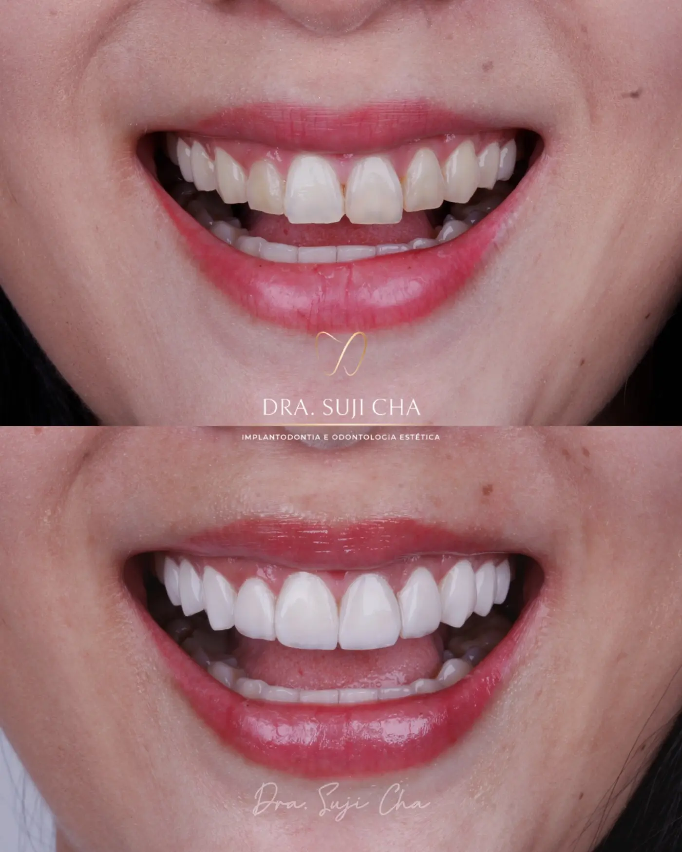 Antes e depois de caso clínico de estética dental