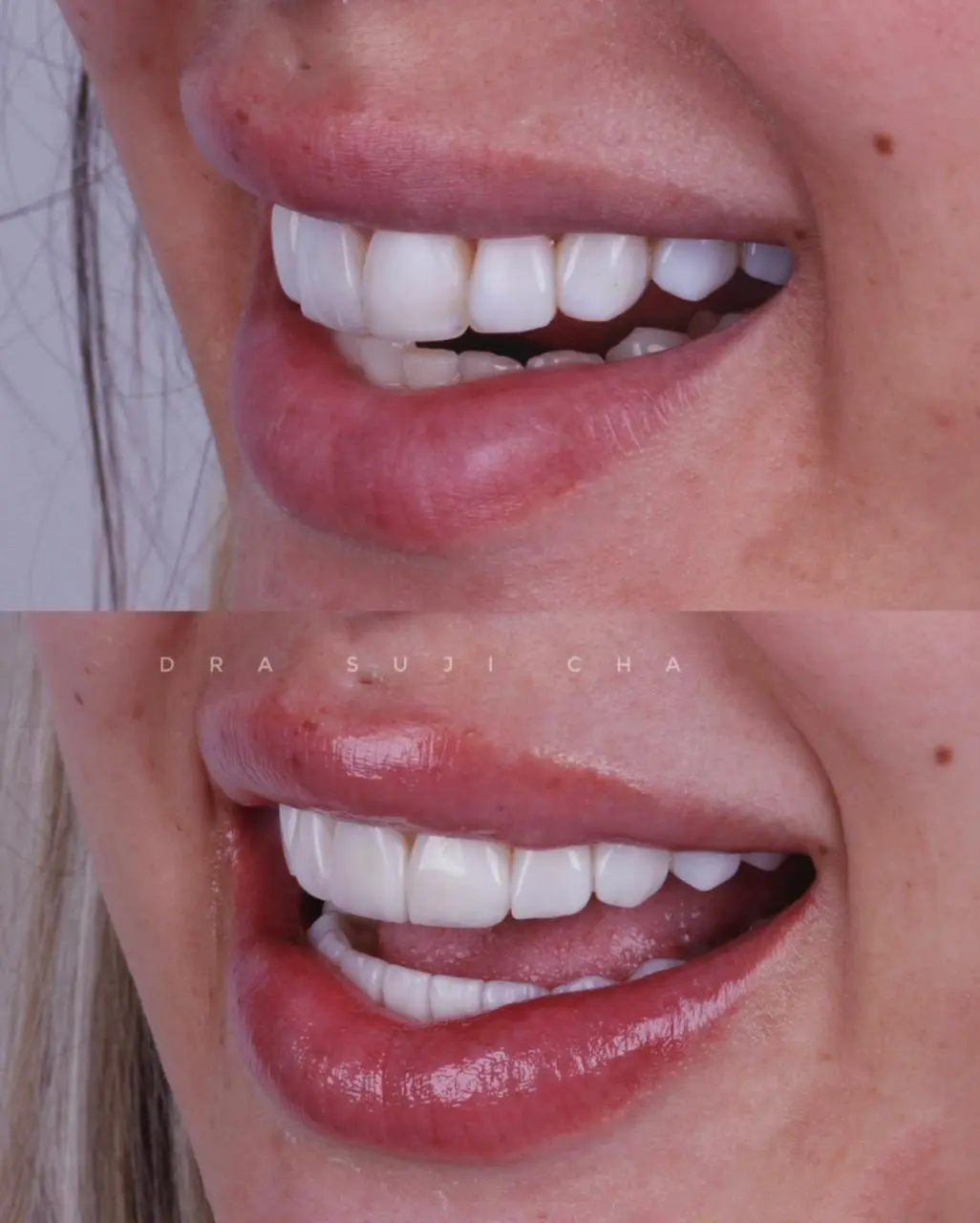 Antes e depois de caso clínico de estética dental