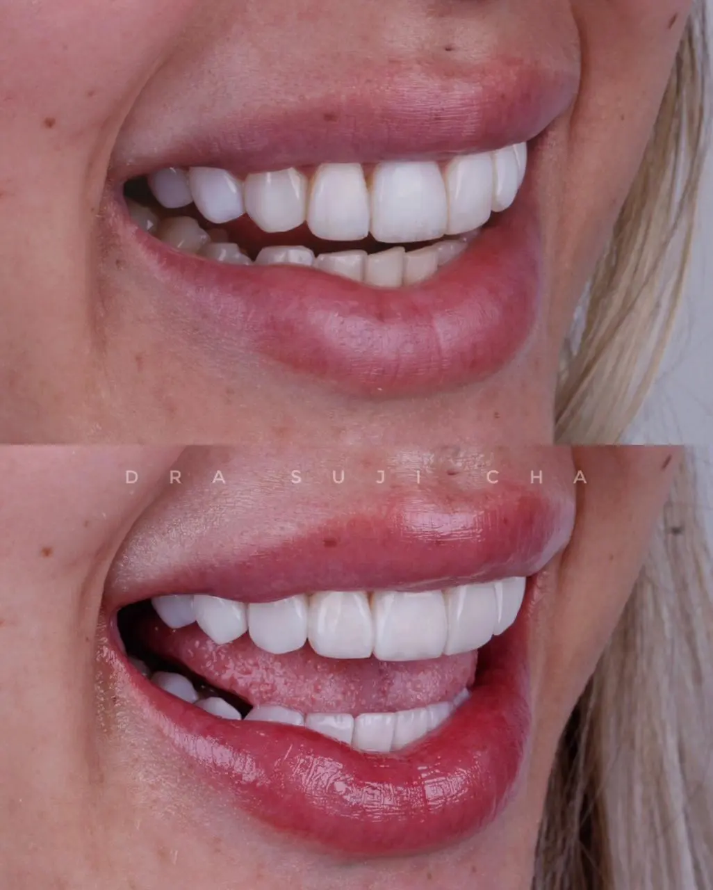 Antes e depois de caso clínico de estética dental